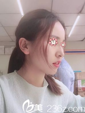 說(shuō)實(shí)在的去韓國(guó)麗穎整形外科做面部吸脂+假體隆鼻之前我也挺忐忑的