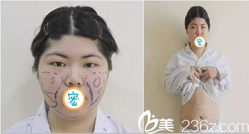 面部吸脂及腰腹部吸脂術(shù)前設(shè)計