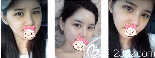 鄭州柏麗芙眼部整形術后3天