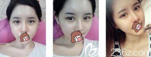 柏麗芙眼部整形后1個月