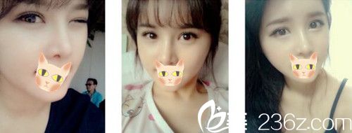 選擇在鄭州柏麗芙變美 看看我除了眼鼻整形還做了啥項目