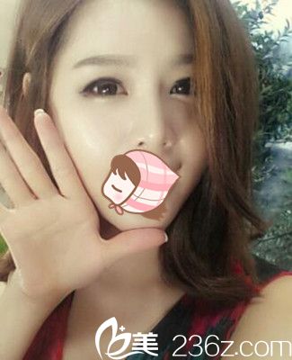 鄭州柏麗芙眼部整形案例