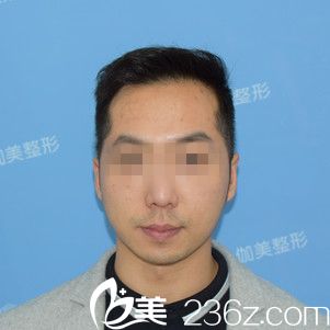 術(shù)前正面 術(shù)前正面