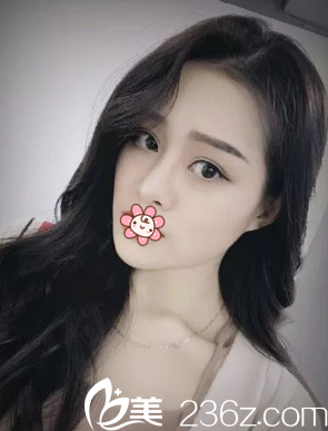 要不是男人現(xiàn)實(shí)我至于找韓國(guó)星愿整形高國(guó)鎮(zhèn)做雙眼皮+肋軟骨隆鼻么