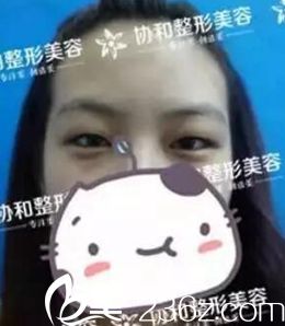 全切雙眼皮案例圖 全切雙眼皮案例圖