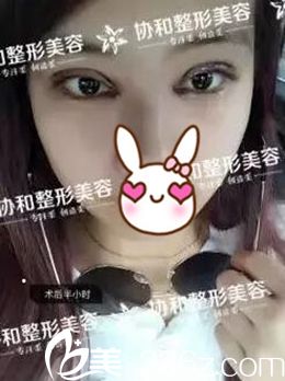 做完全切雙眼皮當(dāng)天 做完全切雙眼皮當(dāng)天