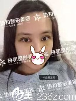 做完全切雙眼皮第四天 做完全切雙眼皮第四天