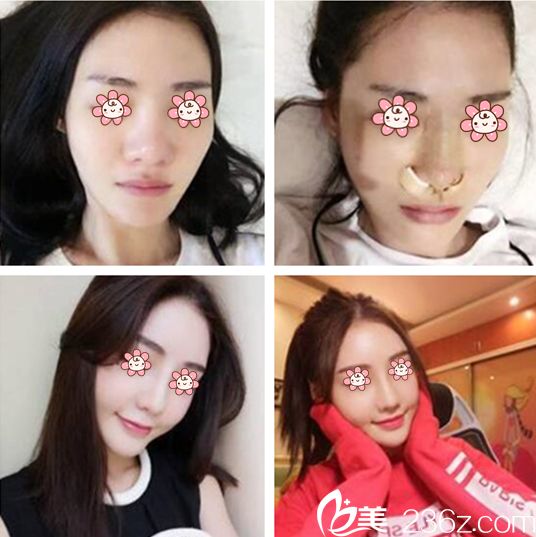 金善球院長(zhǎng)鼻整形案例 金善球院長(zhǎng)鼻整形案例