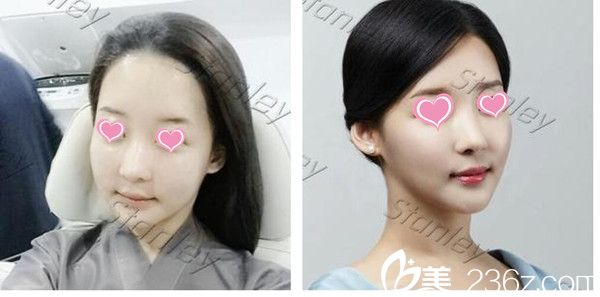 韓國(guó)史丹利皮膚整形醫(yī)院注射案例 韓國(guó)史丹利皮膚整形醫(yī)院注射案例