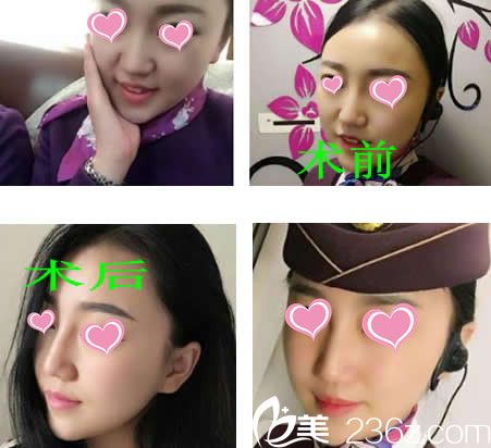 玻尿酸注射隆鼻前后效果對比圖 玻尿酸注射隆鼻前后效果對比圖