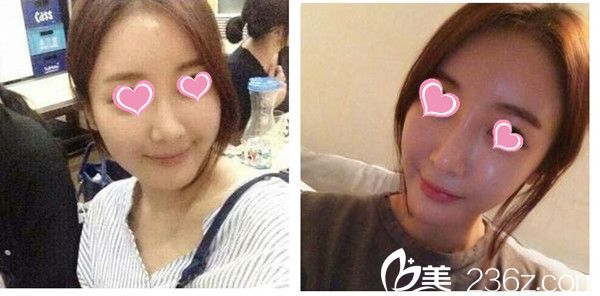 李恩錫院長埋線提升整形手術(shù)真人案例