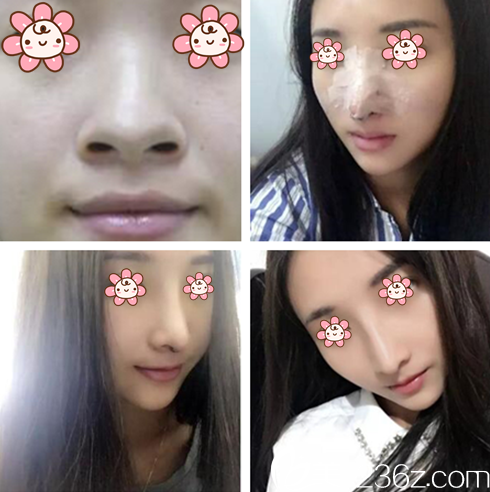 金太煥院長(zhǎng)隆鼻案例 金太煥院長(zhǎng)隆鼻案例