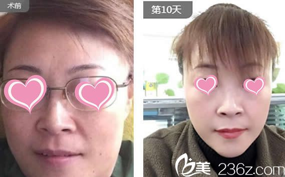 果酸煥膚效果案例 果酸煥膚效果案例