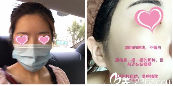 尹聖恩院長紋眉案例 尹聖恩院長紋眉案例