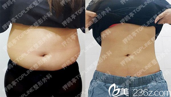 韓國狎鷗亭TOPLINE整形醫(yī)院腹部吸脂案例 韓國狎鷗亭TOPLINE整形醫(yī)院腹部吸脂案例