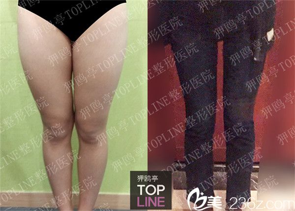 韓國狎鷗亭TOPLINE整形醫(yī)院腿部吸脂案例 韓國狎鷗亭TOPLINE整形醫(yī)院腿部吸脂案例