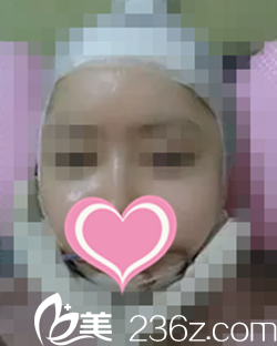 做輪廓手術(shù)當天