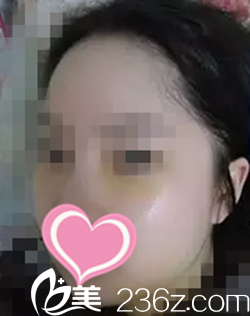 手術(shù)后一周