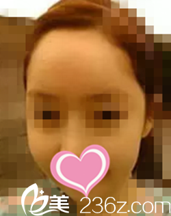 術(shù)后一個月效果