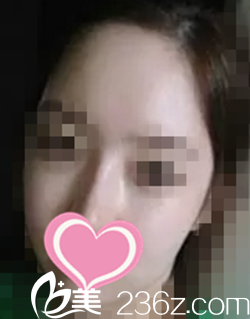 輪廓整形術(shù)后2個月效果