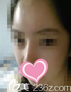 分享我在韓國(guó)white懷特整形醫(yī)院做面部輪廓術(shù)后3個(gè)月“變臉”全程記錄