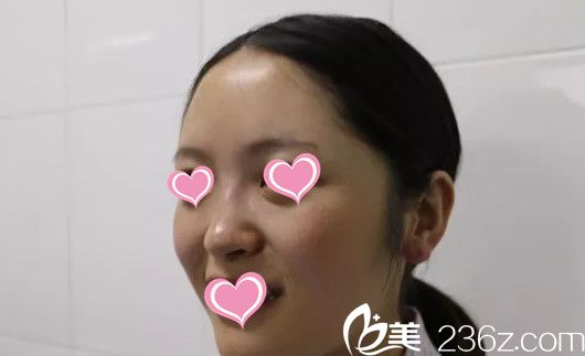 蘭州圣莫麗斯假體隆鼻前 蘭州圣莫麗斯假體隆鼻前