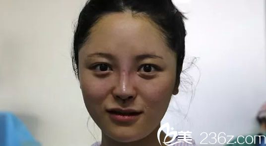 鼻整形手術(shù)當(dāng)天 鼻整形手術(shù)當(dāng)天