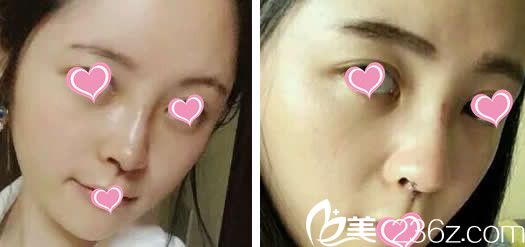 做了假體隆鼻第五天 做了假體隆鼻第五天