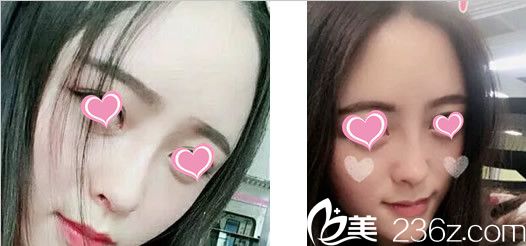 鼻整形15天圖片 鼻整形15天圖片