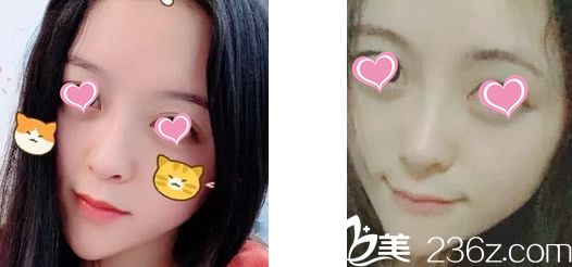 我在蘭州圣莫麗斯找彭斌醫(yī)生做了假體隆鼻 第七天拆線后才敢低頭