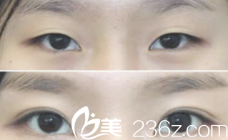 雙眼皮手術(shù)前后對(duì)比 雙眼皮手術(shù)前后對(duì)比