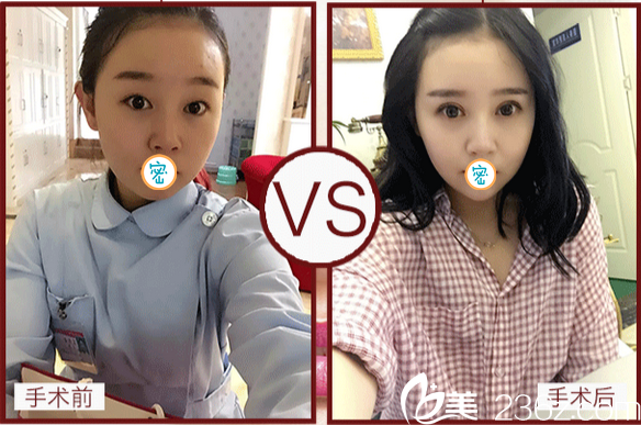 韓式微創(chuàng)雙眼皮前后對(duì)比