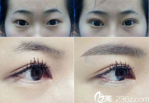 聊城韓美雙眼皮和半紋眉案例對比圖