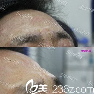 玻尿酸除皺注射后效果