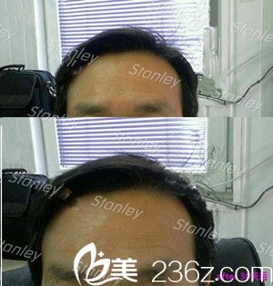 好開心！韓國(guó)史丹利整形醫(yī)院李恩錫一個(gè)玻尿酸就讓老爸年輕了好幾歲