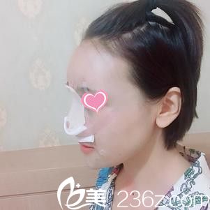 隆鼻+自體脂肪填充術(shù)后天 隆鼻+自體脂肪填充術(shù)后天