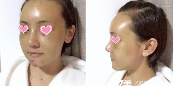 鄭太英院長真人隆鼻手術(shù)案例分享 鄭太英院長真人隆鼻手術(shù)案例分享