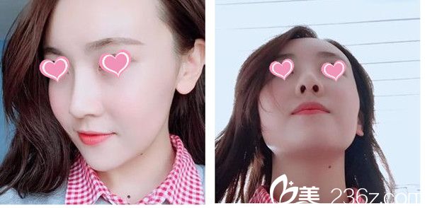 術(shù)后兩個(gè)月效果 術(shù)后兩個(gè)月效果