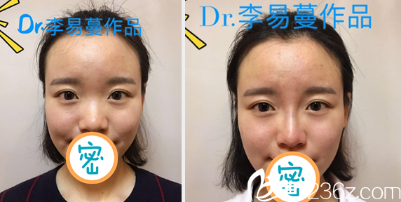 達(dá)州雙均李易蔓線雕隆鼻案例對比 達(dá)州雙均李易蔓線雕隆鼻案例對比