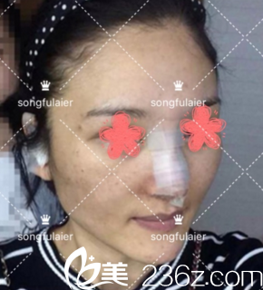 鼻綜合手術(shù)后3天 鼻綜合手術(shù)后3天