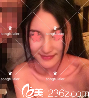 有圖有真相，沒(méi)想到我在韓國(guó)頌富萊爾整形醫(yī)院做的鼻綜合效果這么好！