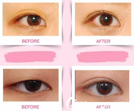 世賢整形醫(yī)院眼部案例