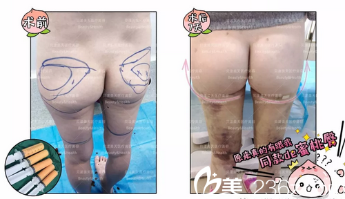 深圳貝漾美天董磊自體脂肪豐臀案例對比圖