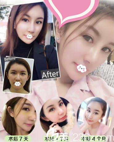 深圳貝漾美天曹思佳做的雙眼皮和隆鼻案例 深圳貝漾美天曹思佳做的雙眼皮和隆鼻案例