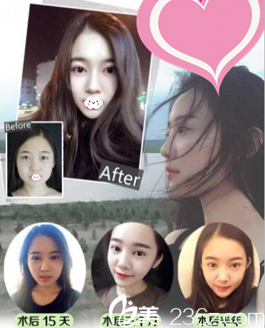 深圳貝漾美天曹思佳貝塞爾無痕雙眼皮案例術(shù)后半年效果圖 深圳貝漾美天曹思佳貝塞爾無痕雙眼皮案例術(shù)后半年效果圖