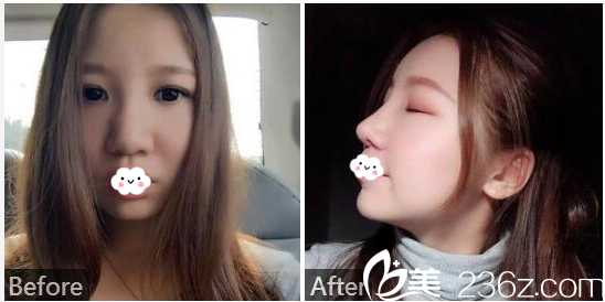 深圳貝漾美天胡佰春醫(yī)生做的隆鼻案例