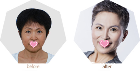 北京上上相整形美容醫(yī)院面部精雕案例