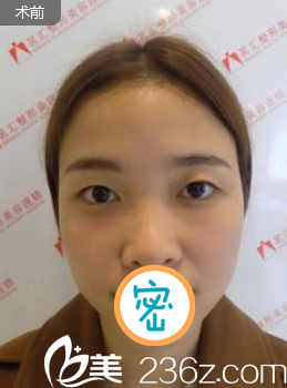 切開雙眼皮術前眼睛無神 切開雙眼皮術前眼睛無神