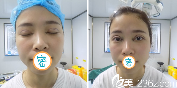 雙眼皮術前設計及術后即刻效果 雙眼皮術前設計及術后即刻效果