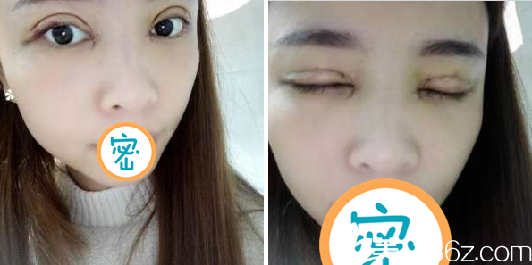 切開雙眼皮術后5天睜眼閉眼效果 切開雙眼皮術后5天睜眼閉眼效果